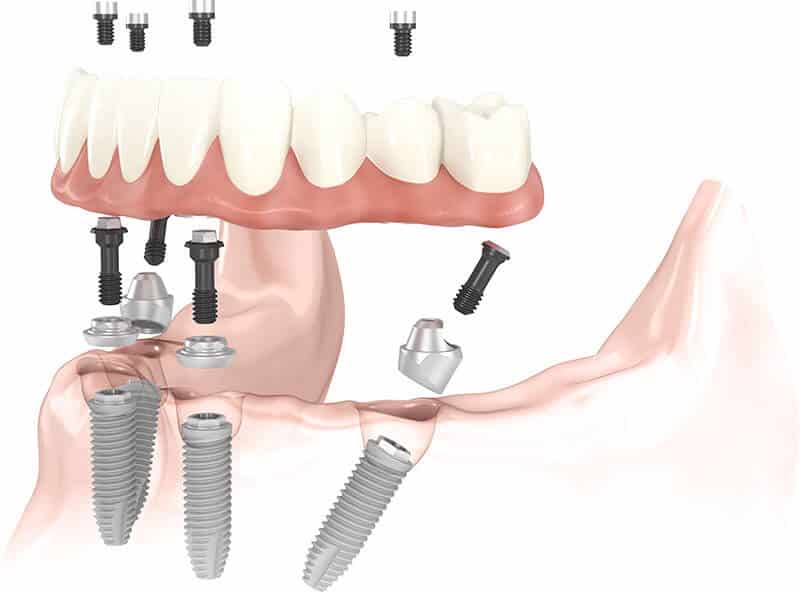 dental implants in south wales