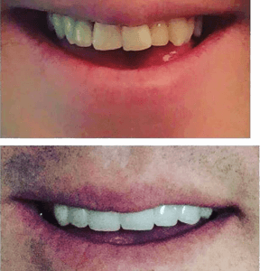 Smile Makeover - Before and After