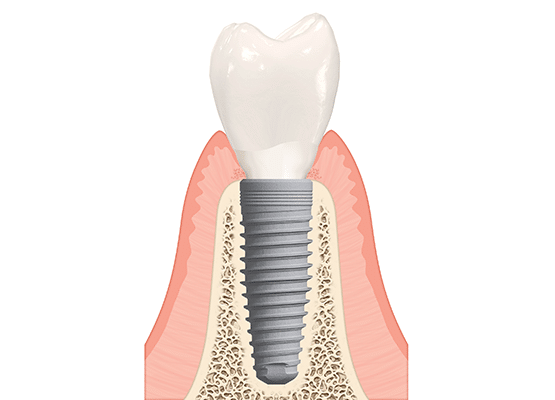 dental implants newport