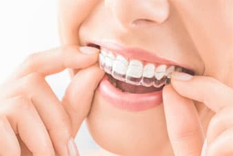 invisalign south wales